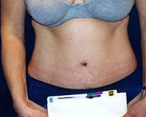 Tummy Tuck Patient 67379 Photo 2