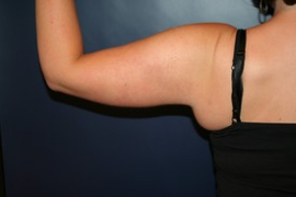 Arm Liposuction and Arm Brachioplasty Patient 40639 Photo 4