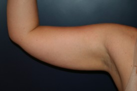 Arm Liposuction Patient 71555 Photo 1
