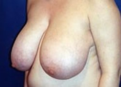 Breast Lift Patient 14022 Photo 3