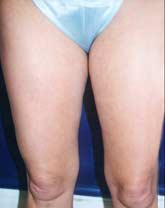 Liposculpture/Liposuction Patient 79741 Photo 5