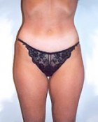 Liposculpture/Liposuction Patient 10999 Photo 1