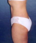 Liposculpture/Liposuction Patient 74733 Photo 2