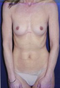 Breast Augmentation Patient 36568 Photo 1