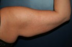 Arm Liposuction and Arm Brachioplasty Patient 40639 Photo 1