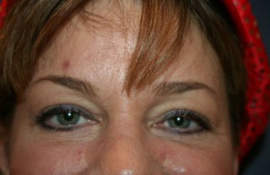 Eyelid Surgery Patient 23084 Photo 6