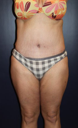 Tummy Tuck Patient 95363 Photo 4