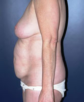 Tummy Tuck Patient 51867 Photo 3