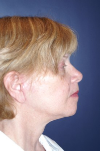 Facelift Patient 67251 Photo 4