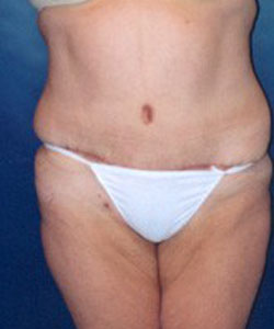 Tummy Tuck Patient 49099 Photo 4