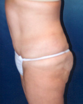 Tummy Tuck Patient 31720 Photo 4