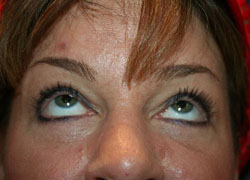 Eyelid Surgery Patient 23084 Photo 2