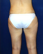 Liposculpture/Liposuction Patient 77135 Photo 6