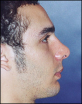 Rhinoplasty Patient 90492 Photo 4