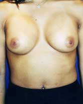 Breast Revision Patient 74609 Photo 2