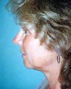 Facelift Patient 20587 Photo 1