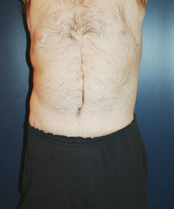 Tummy Tuck Patient 97317 Photo 4