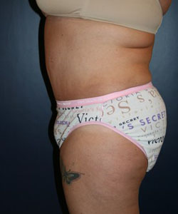 Tummy Tuck Patient 29857 Photo 2