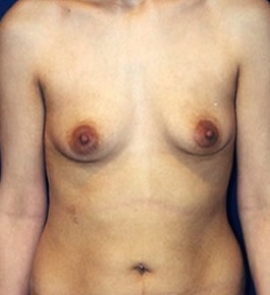 Breast Augmentation Patient 88481 Photo 1