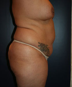 Tummy Tuck Patient 76738 Photo 3