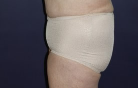 Tummy Tuck Patient 57518 Photo 4