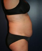 Liposculpture/Liposuction Patient 44612 Photo 1