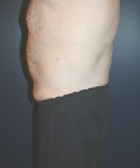 Tummy Tuck Patient 97317 Photo 2