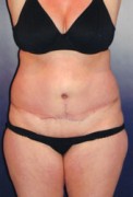 Tummy Tuck Patient 98082 Photo 2