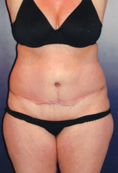 Tummy Tuck Patient 98082 Photo 2