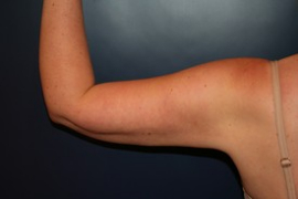 Arm Liposuction Patient 71555 Photo 4