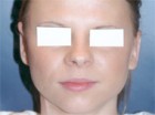 Otoplasty Patient 35144 Photo 2