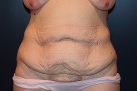 Tummy Tuck Patient 12770 Photo 3