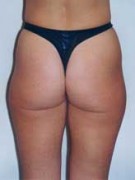 Liposculpture/Liposuction Patient 81120 Photo 1