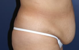 Tummy Tuck Patient 57392 Photo 3