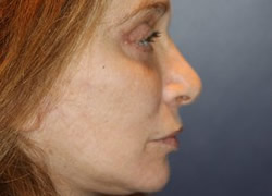 Eyelid Surgery Patient 29663 Photo 4