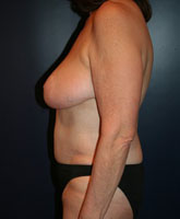 Tummy Tuck Patient 51867 Photo 4