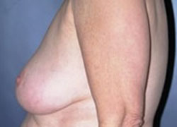 Breast Lift Patient 16247 Photo 1