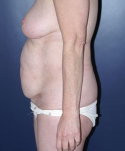 Tummy Tuck Patient 72081 Photo 1