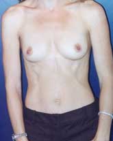 Breast Augmentation Patient 92725 Photo 1