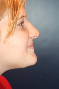 Rhinoplasty Patient 99231 Photo 2