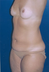 Breast Augmentation Patient 50635 Photo 5