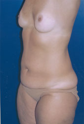 Breast Augmentation Patient 50635 Photo 5
