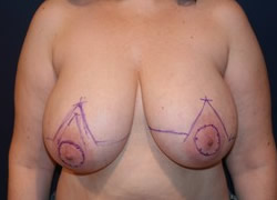 Breast Reduction Patient 66421 Photo 1
