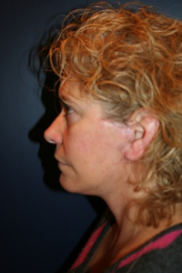 Facelift Patient 86307 Photo 2