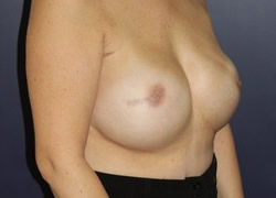 Breast Reconstruction Patient 30200 Photo 4