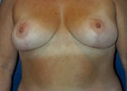 Breast Reduction Patient 50356 Photo 2