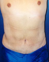 Male Liposuction Patient 64775 Photo 2