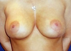 Breast Reduction Patient 81037 Photo 2