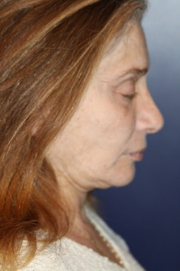 Facelift Patient 71182 Photo 3