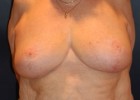 Breast Reduction Patient 28581 Photo 2